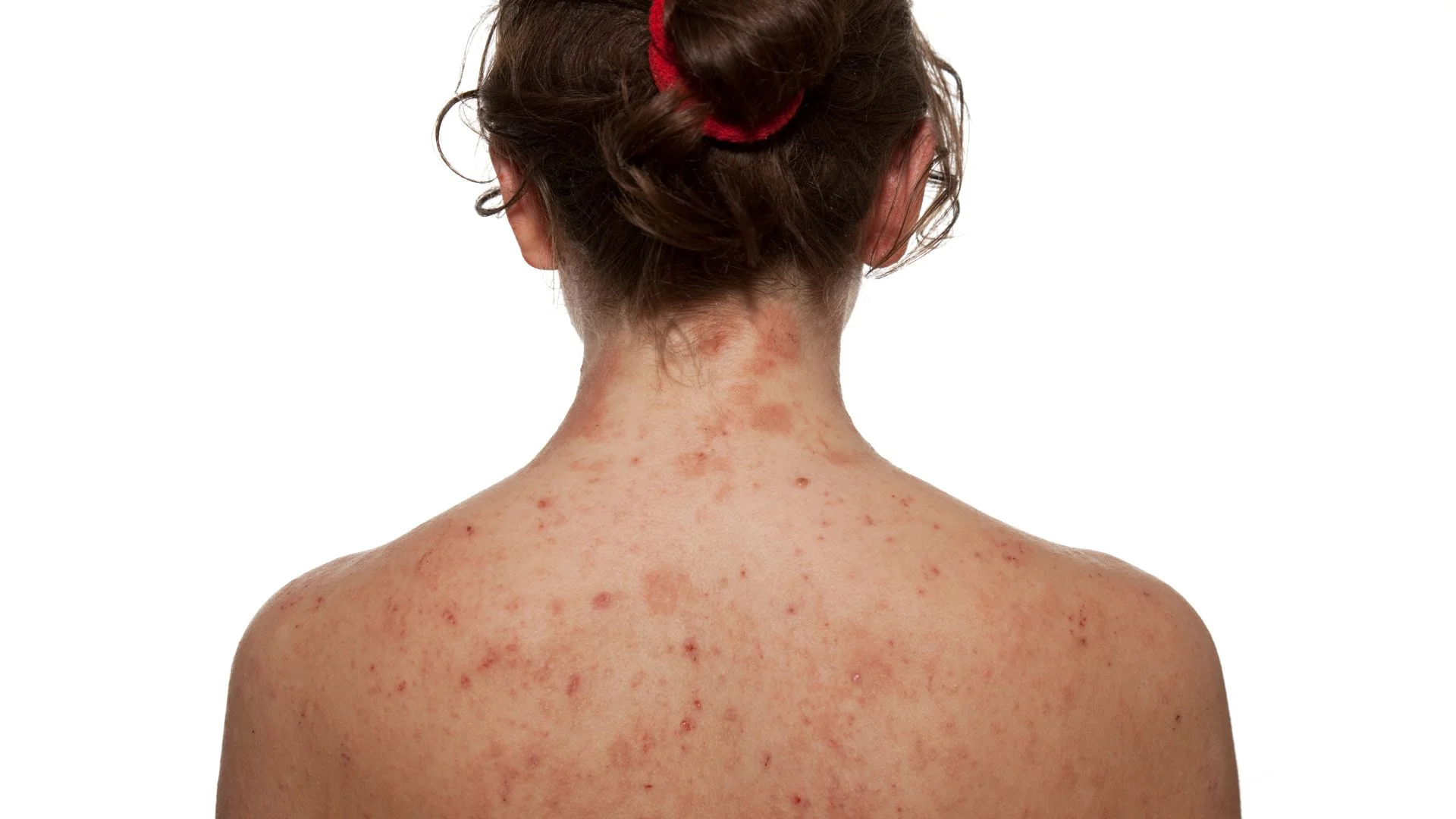 Dermatitis