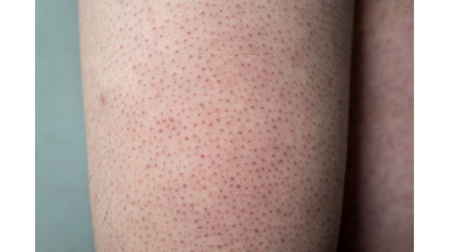 Bedeutung: Keratosis Pilaris » NINON Kosmetik Akademie