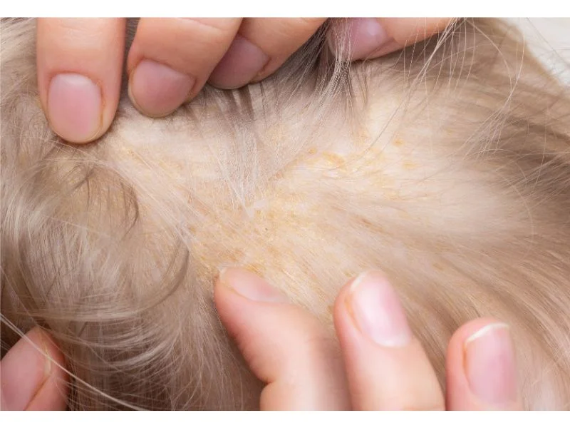 Seborrhische Dermatitis