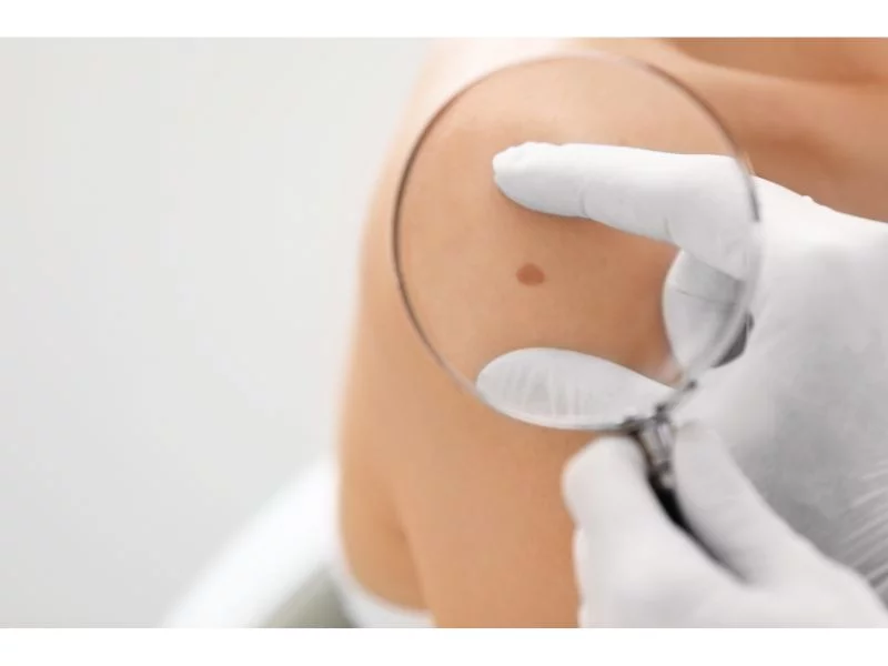 Hautkrebs-Screening