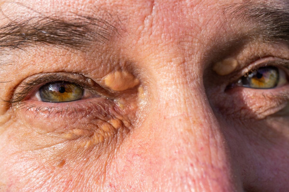 Xanthelasma