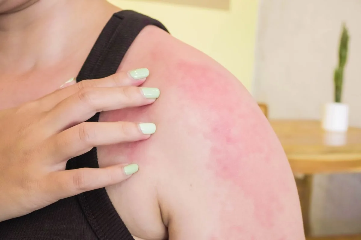 Allergie