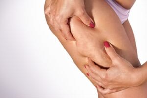 Cellulite oel