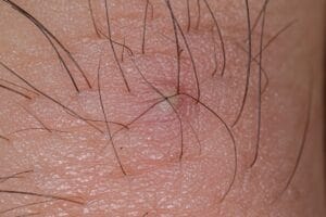 Eingewachsene Haare