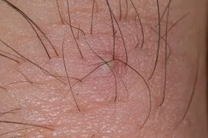 Eingewachsene Haare