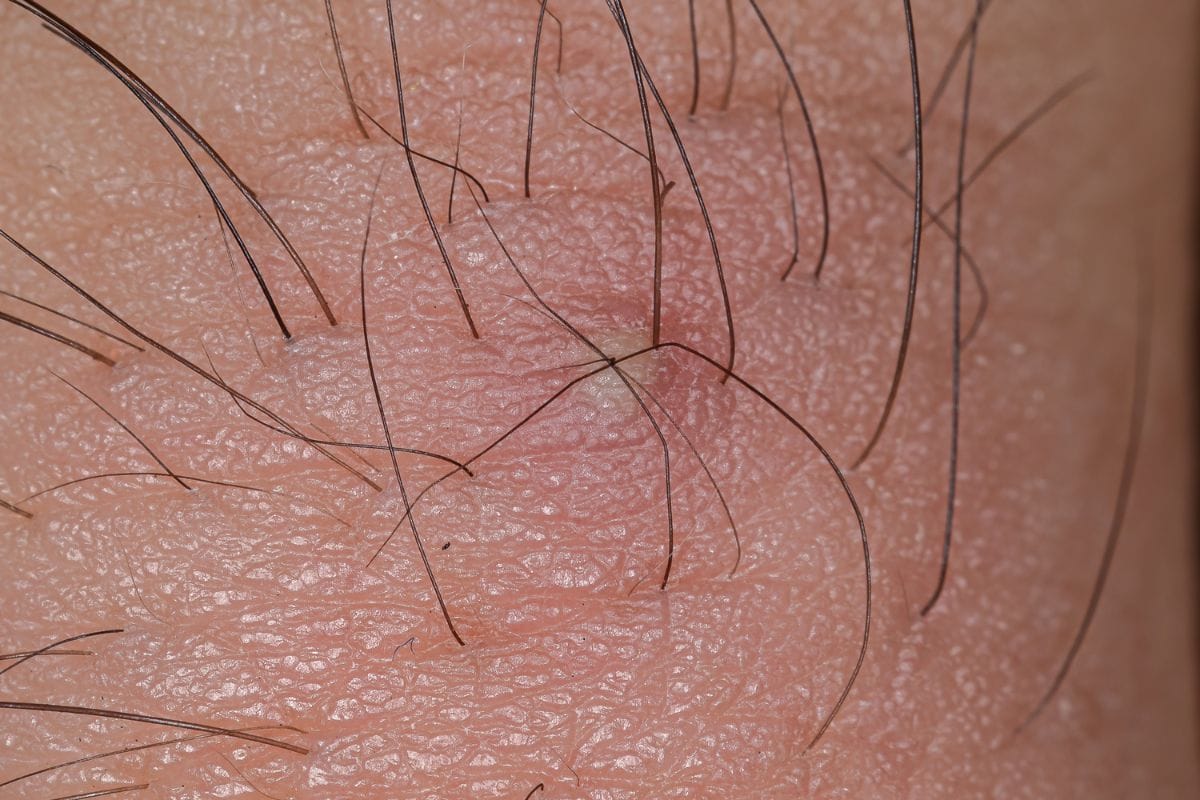 Eingewachsene Haare