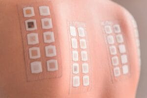 Epikutantest