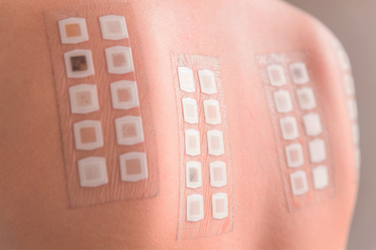 Epikutantest