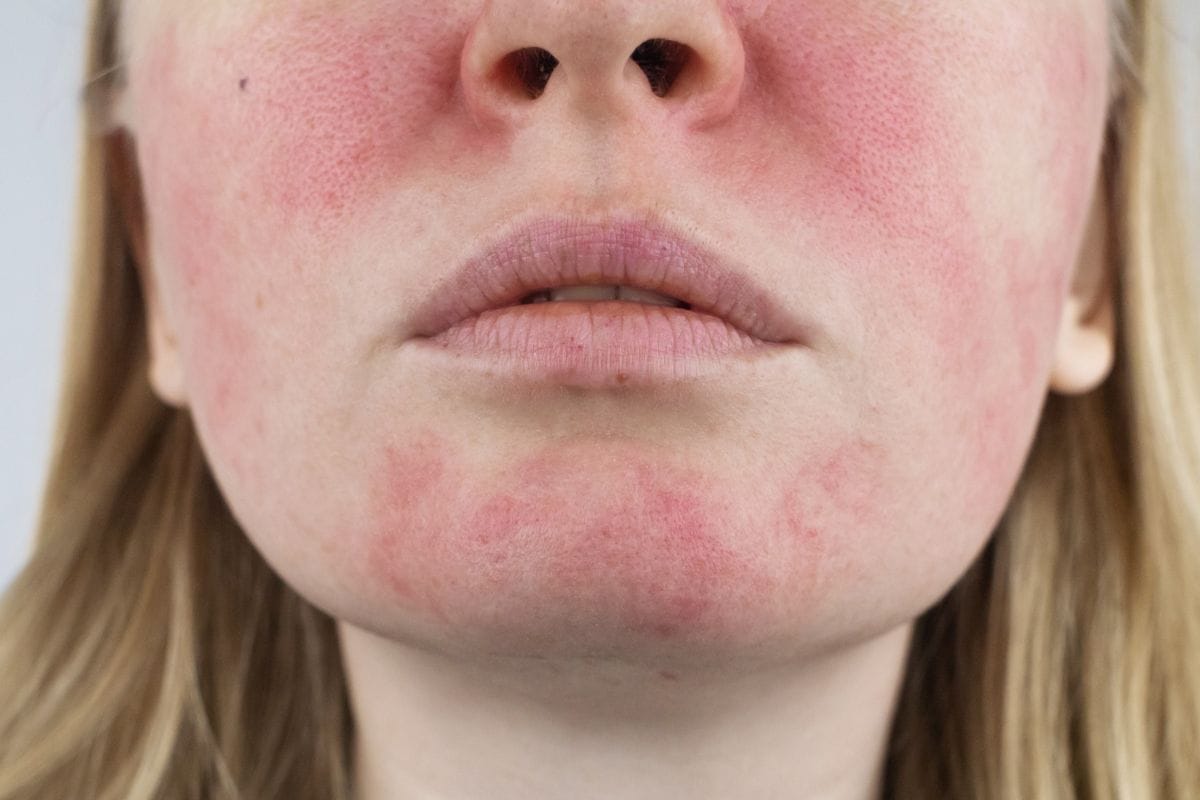 Erythrose