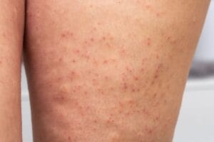 Follikulitis