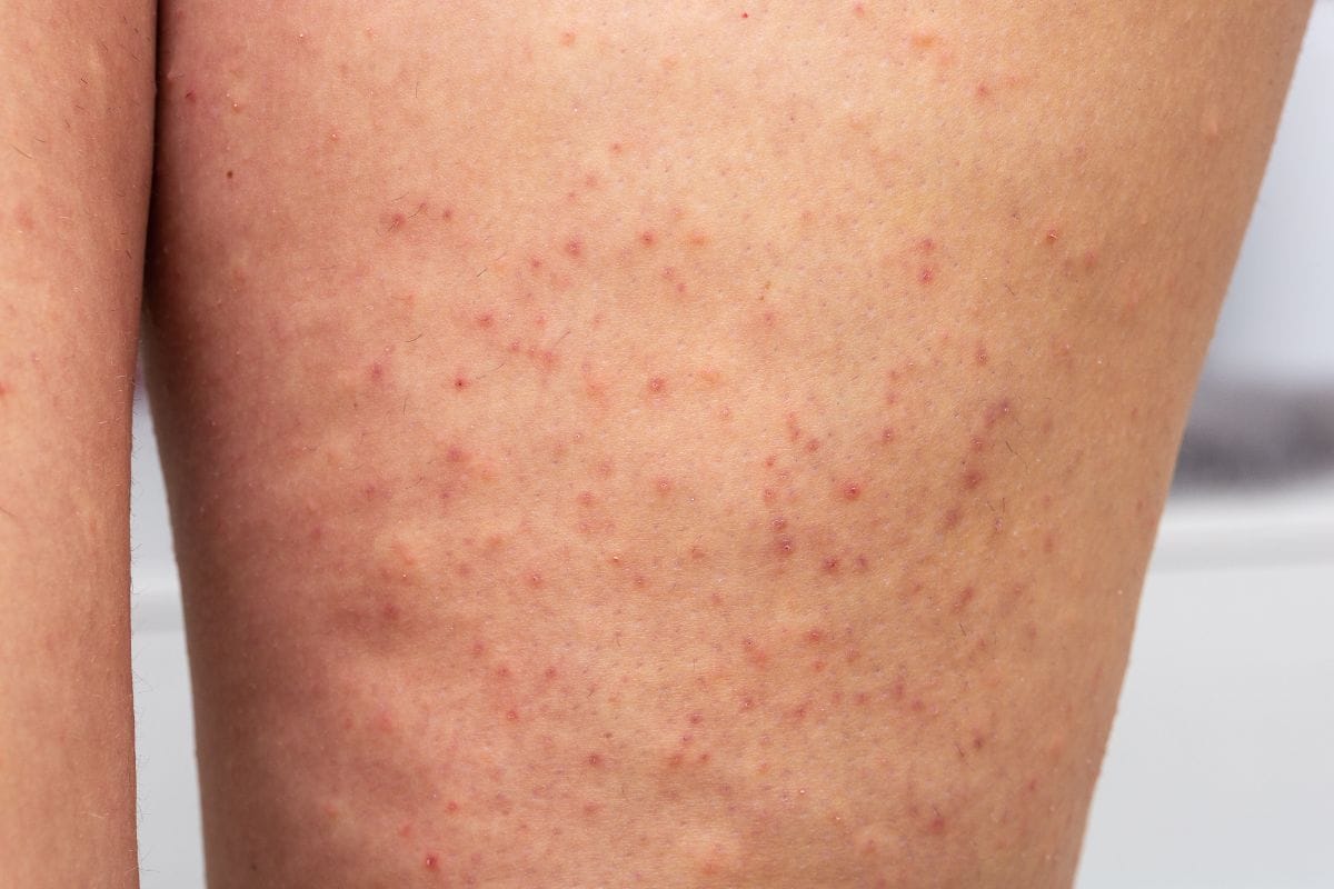 Follikulitis