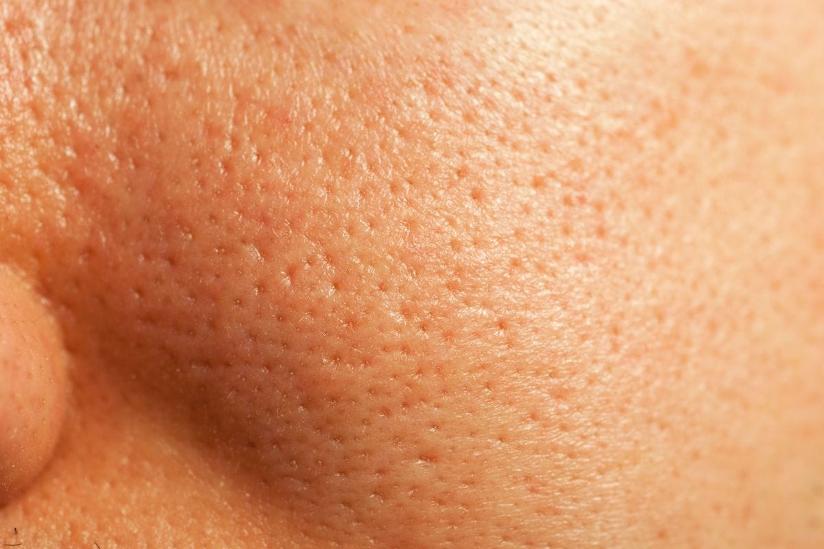 Sebumueberschuss